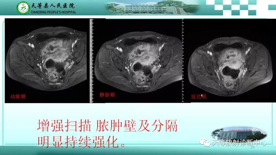 影像PPT - 【PPT】输卵管卵巢脓肿CT、MRI诊断及鉴别诊断-25 影像PPT - 【PPT】输卵管卵巢脓肿CT、MRI诊断及鉴别诊断-25