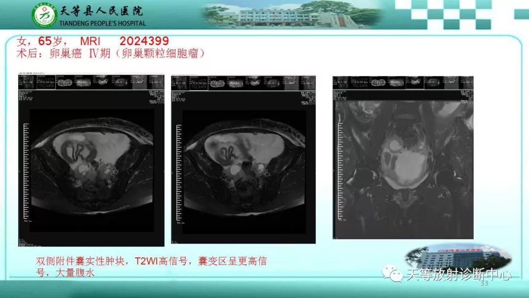 影像PPT - 【PPT】输卵管卵巢脓肿CT、MRI诊断及鉴别诊断-33 影像PPT - 【PPT】输卵管卵巢脓肿CT、MRI诊断及鉴别诊断-33