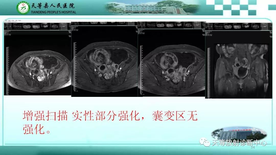 影像PPT - 【PPT】输卵管卵巢脓肿CT、MRI诊断及鉴别诊断-34 影像PPT - 【PPT】输卵管卵巢脓肿CT、MRI诊断及鉴别诊断-34