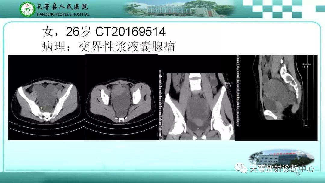 影像PPT - 【PPT】输卵管卵巢脓肿CT、MRI诊断及鉴别诊断-35 影像PPT - 【PPT】输卵管卵巢脓肿CT、MRI诊断及鉴别诊断-35