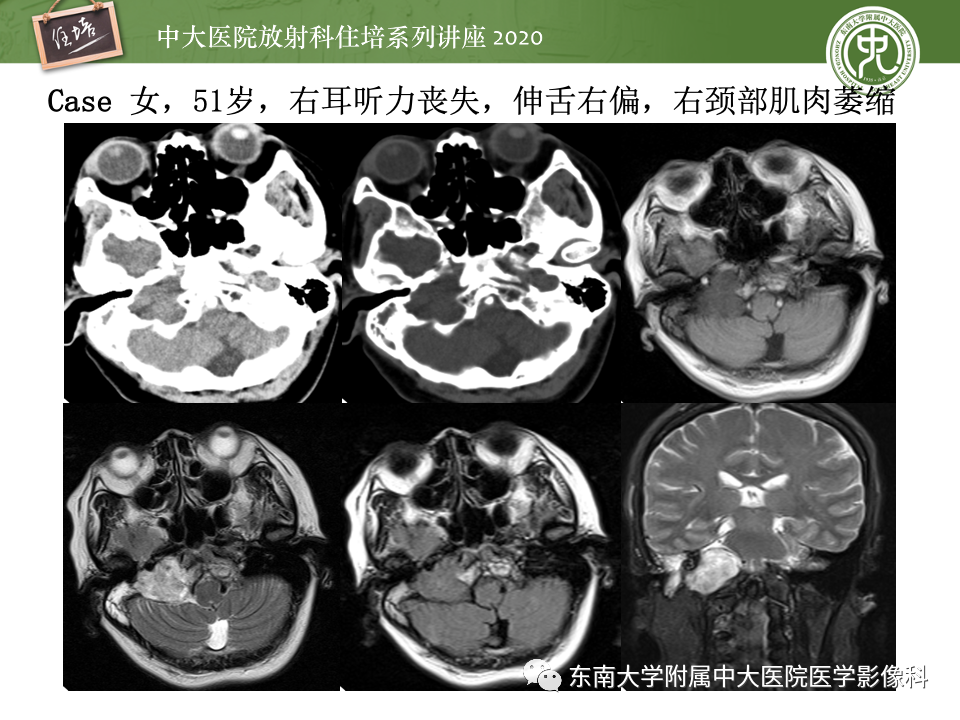 影像PPT - 【PPT】头颈部神经源性肿瘤的影像诊断-6