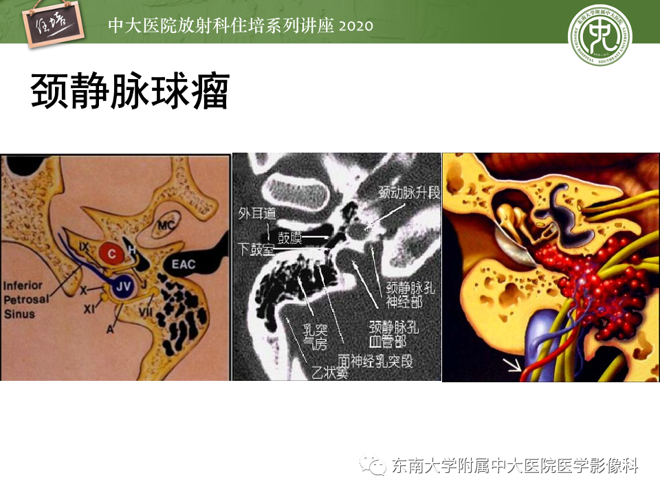 影像PPT - 【PPT】头颈部神经源性肿瘤的影像诊断-8
