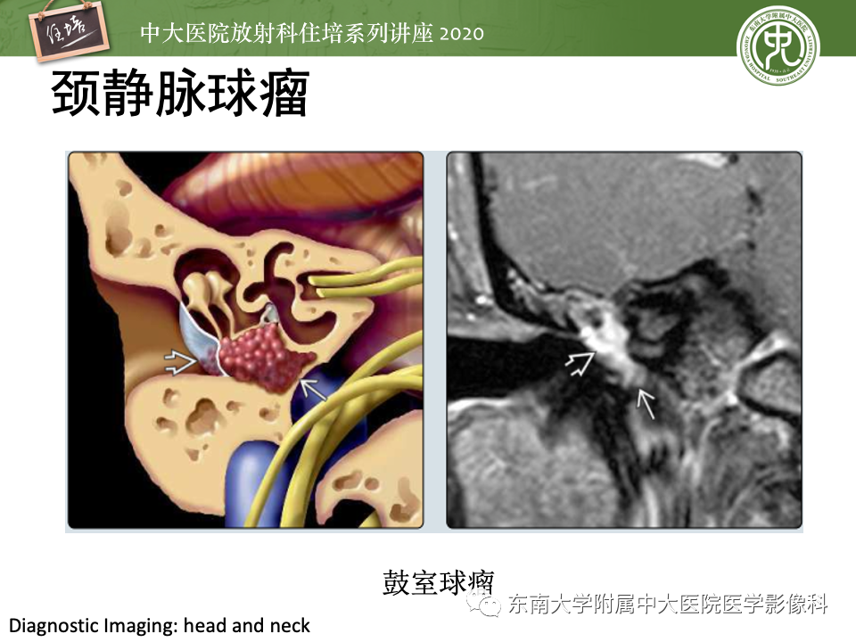 影像PPT - 【PPT】头颈部神经源性肿瘤的影像诊断-13