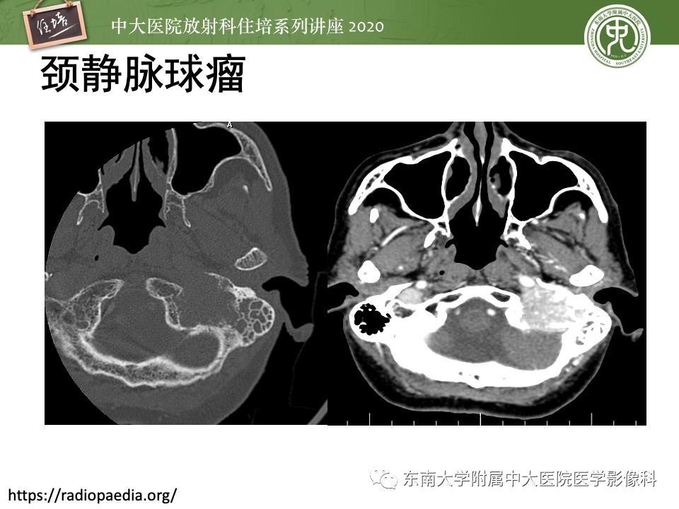 影像PPT - 【PPT】头颈部神经源性肿瘤的影像诊断-14