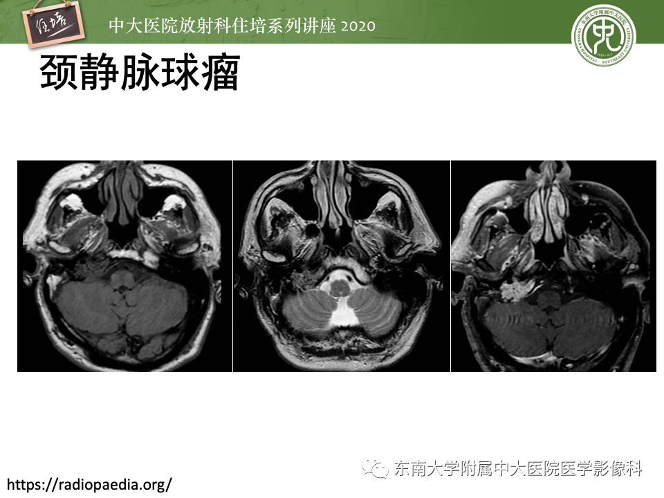 影像PPT - 【PPT】头颈部神经源性肿瘤的影像诊断-15