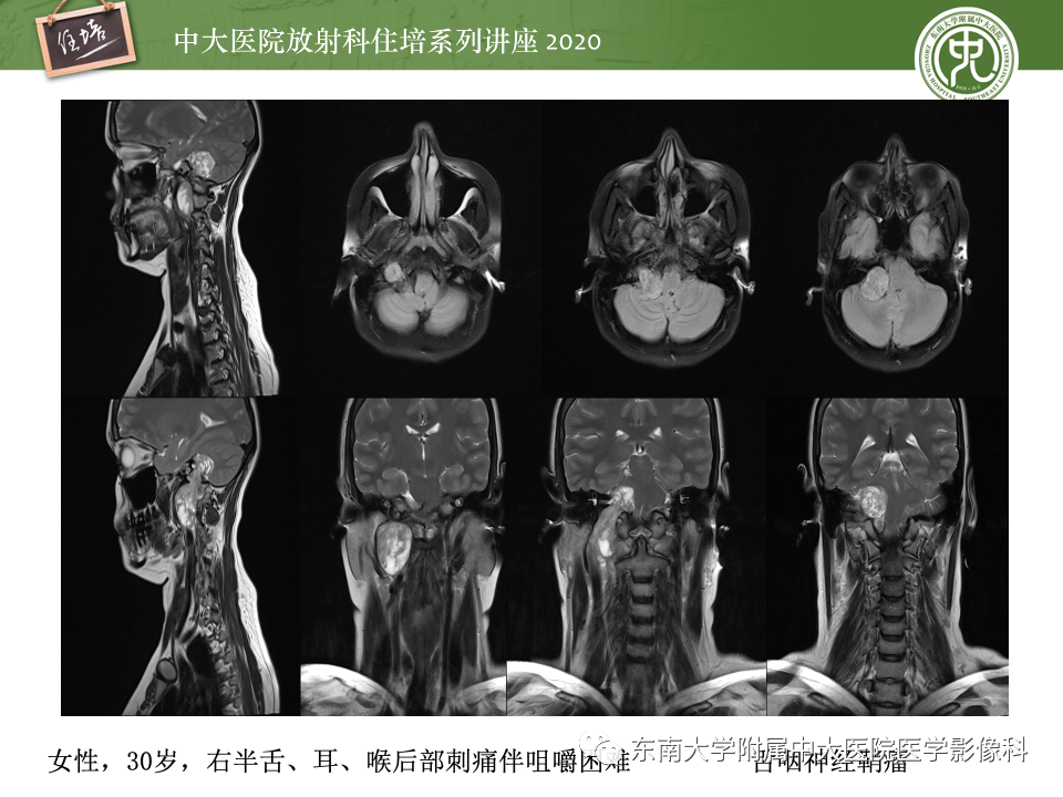 影像PPT - 【PPT】头颈部神经源性肿瘤的影像诊断-18