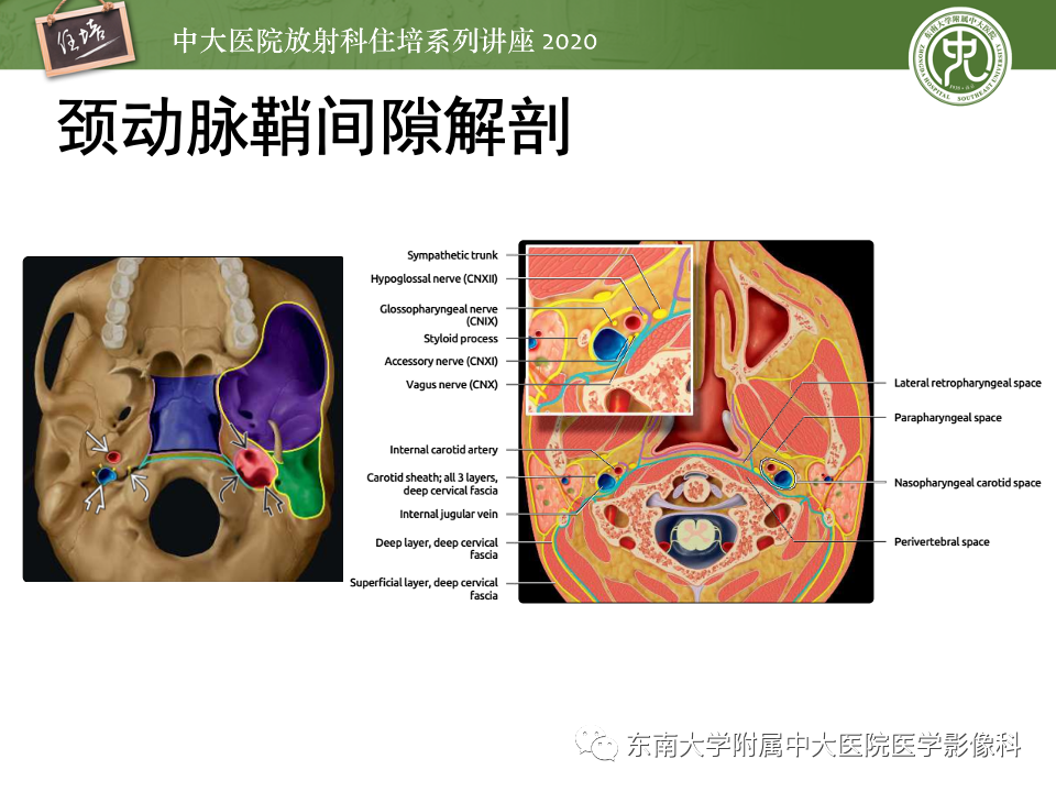 影像PPT - 【PPT】头颈部神经源性肿瘤的影像诊断-20