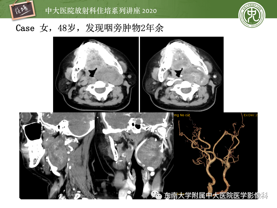 影像PPT - 【PPT】头颈部神经源性肿瘤的影像诊断-22