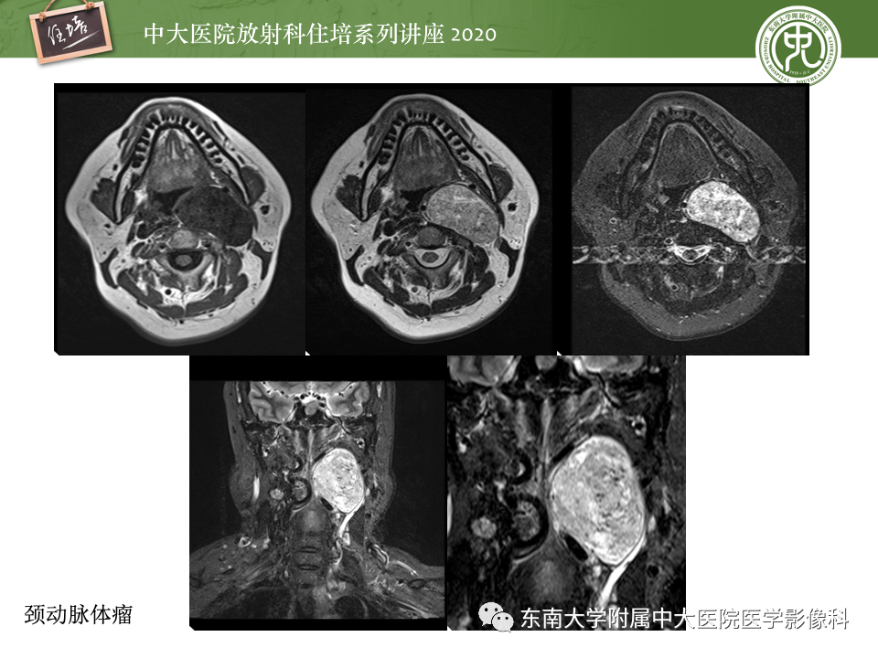 影像PPT - 【PPT】头颈部神经源性肿瘤的影像诊断-23