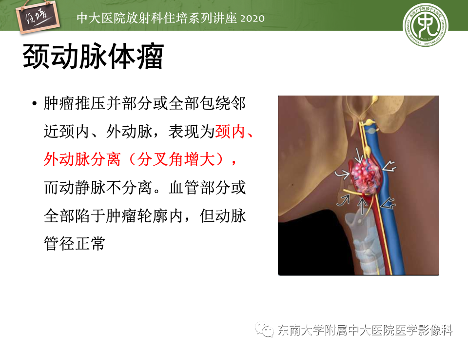 影像PPT - 【PPT】头颈部神经源性肿瘤的影像诊断-26