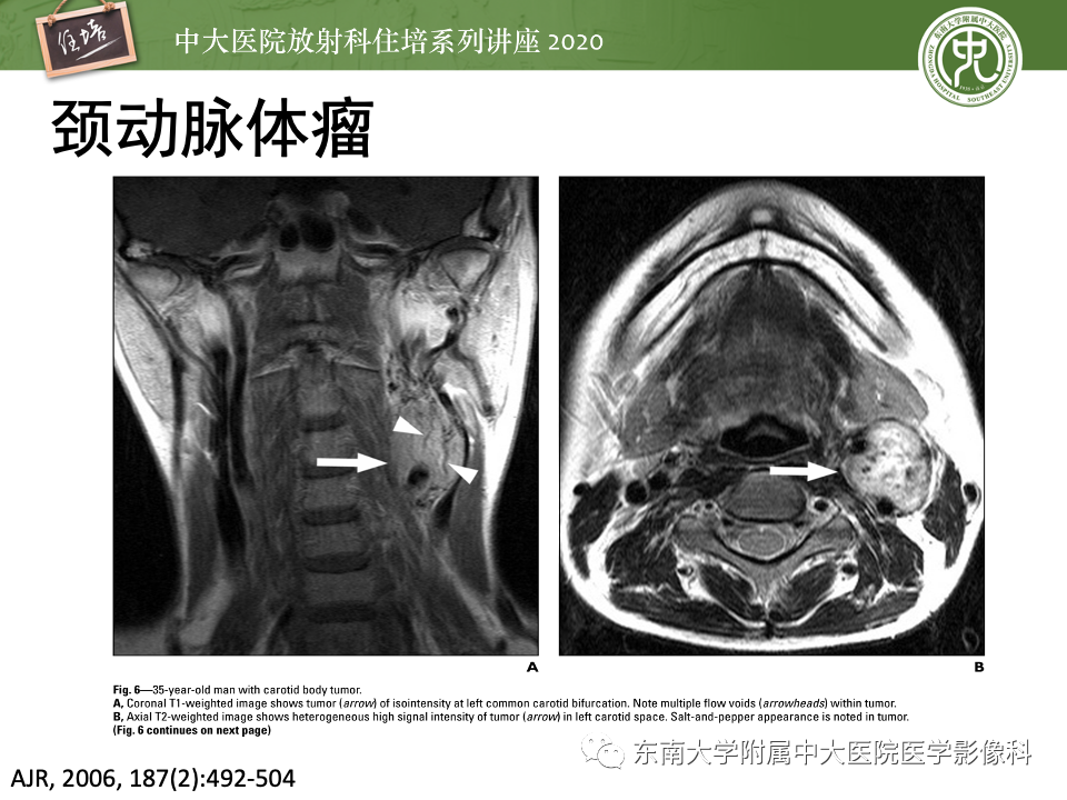 影像PPT - 【PPT】头颈部神经源性肿瘤的影像诊断-27