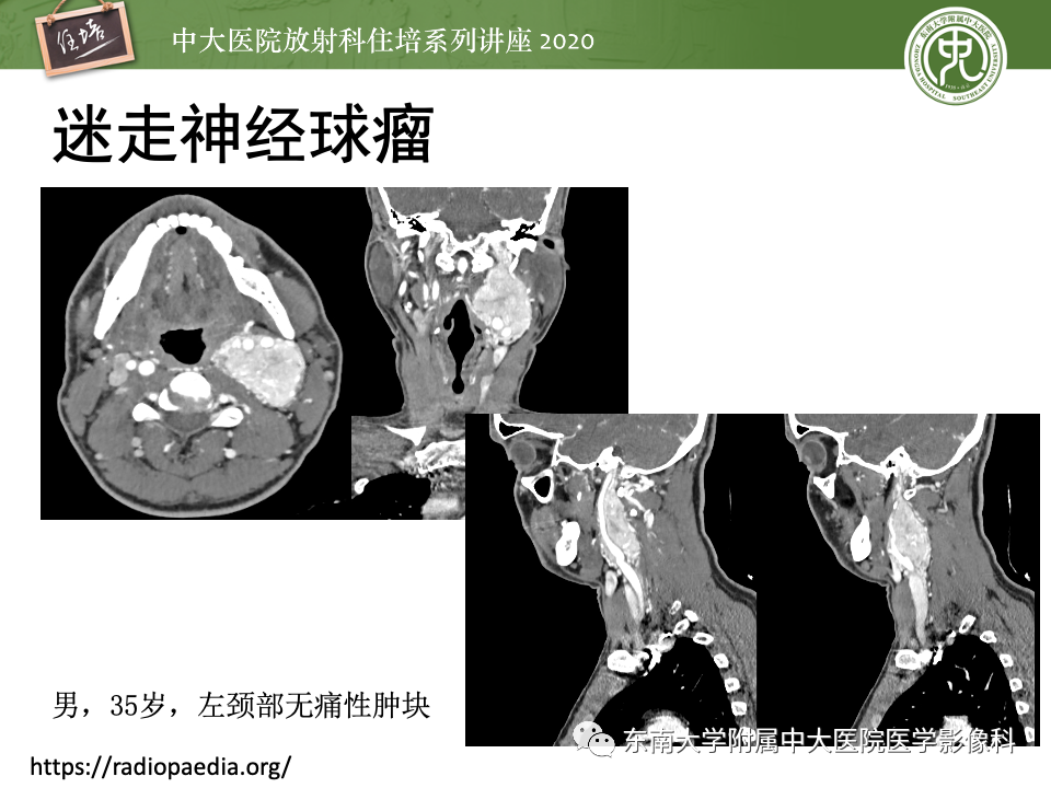 影像PPT - 【PPT】头颈部神经源性肿瘤的影像诊断-30