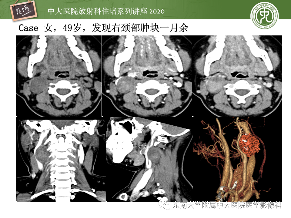 影像PPT - 【PPT】头颈部神经源性肿瘤的影像诊断-31