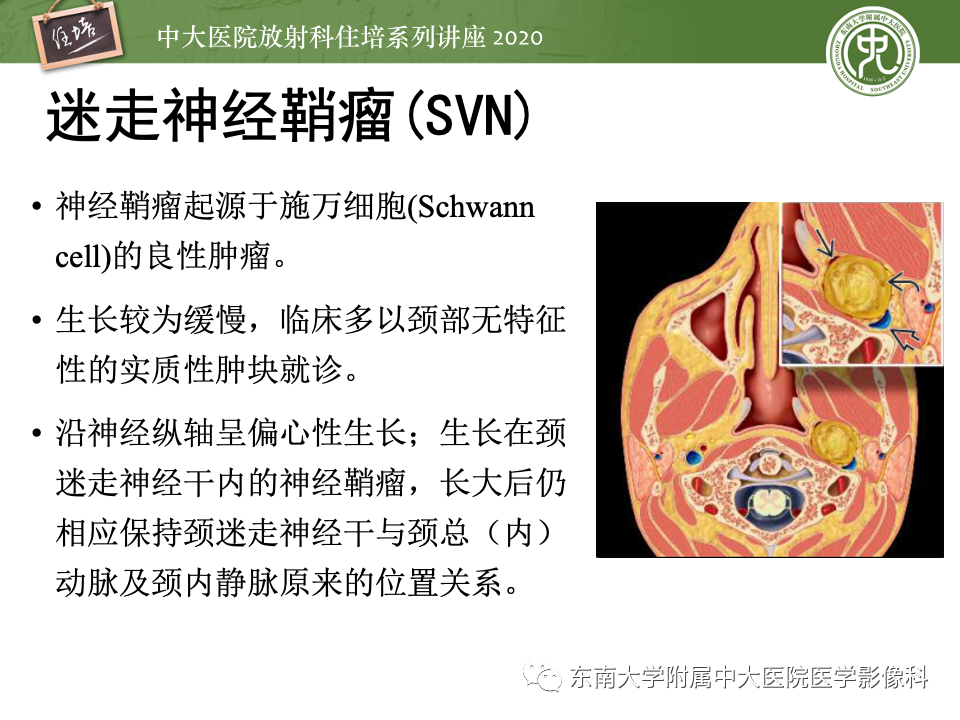 影像PPT - 【PPT】头颈部神经源性肿瘤的影像诊断-33