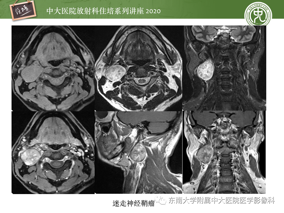 影像PPT - 【PPT】头颈部神经源性肿瘤的影像诊断-37