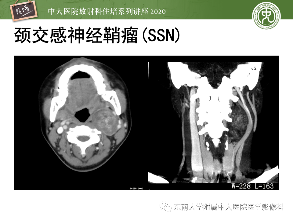 影像PPT - 【PPT】头颈部神经源性肿瘤的影像诊断-40