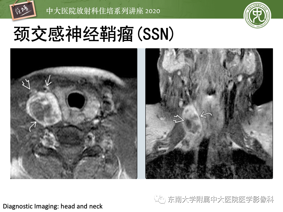 影像PPT - 【PPT】头颈部神经源性肿瘤的影像诊断-41