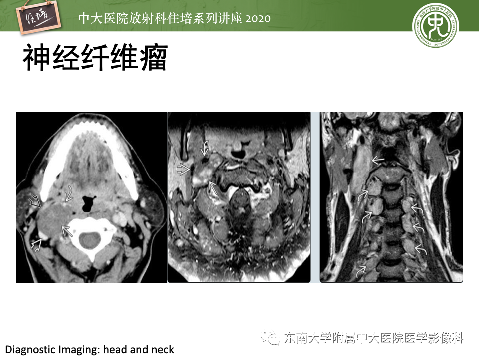 影像PPT - 【PPT】头颈部神经源性肿瘤的影像诊断-43