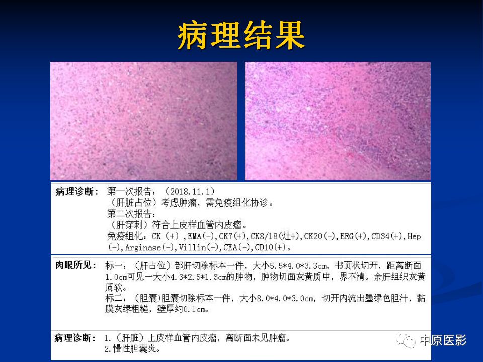 影像PPT - 【PPT】肝脏上皮样血管内皮瘤影像表现-9
