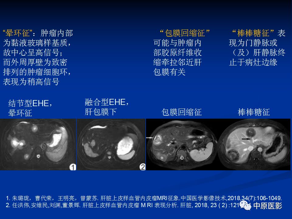 影像PPT - 【PPT】肝脏上皮样血管内皮瘤影像表现-12