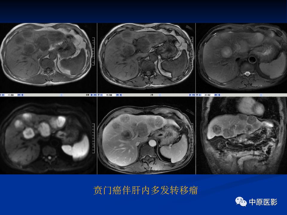 影像PPT - 【PPT】肝脏上皮样血管内皮瘤影像表现-16