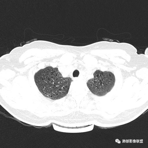 影像PPT - 【病例】中年女性,探秘双肺弥漫性囊腔-7 影像PPT - 【病例】中年女性,探秘双肺弥漫性囊腔-7