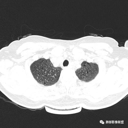 影像PPT - 【病例】中年女性,探秘双肺弥漫性囊腔-6 影像PPT - 【病例】中年女性,探秘双肺弥漫性囊腔-6