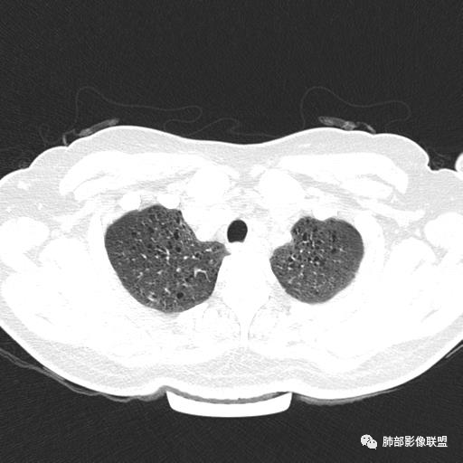 影像PPT - 【病例】中年女性,探秘双肺弥漫性囊腔-8 影像PPT - 【病例】中年女性,探秘双肺弥漫性囊腔-8