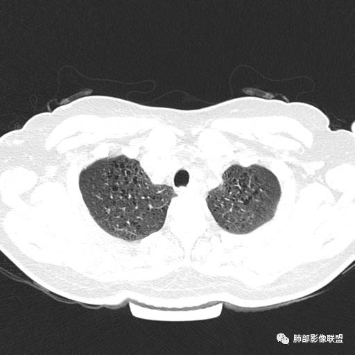 影像PPT - 【病例】中年女性,探秘双肺弥漫性囊腔-9 影像PPT - 【病例】中年女性,探秘双肺弥漫性囊腔-9