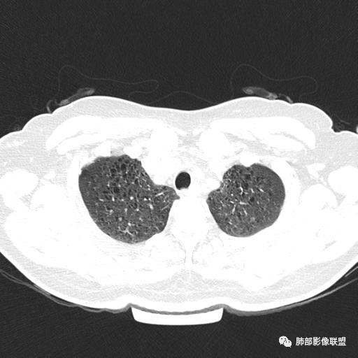 影像PPT - 【病例】中年女性,探秘双肺弥漫性囊腔-10 影像PPT - 【病例】中年女性,探秘双肺弥漫性囊腔-10
