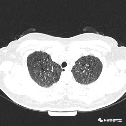影像PPT - 【病例】中年女性,探秘双肺弥漫性囊腔-14 影像PPT - 【病例】中年女性,探秘双肺弥漫性囊腔-14