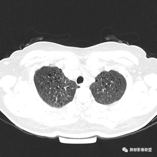 影像PPT - 【病例】中年女性,探秘双肺弥漫性囊腔-12 影像PPT - 【病例】中年女性,探秘双肺弥漫性囊腔-12