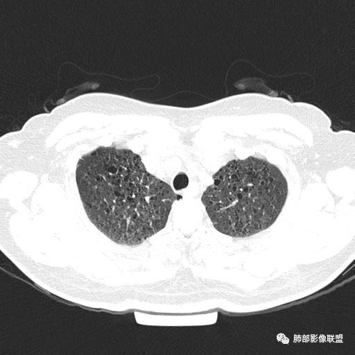 影像PPT - 【病例】中年女性,探秘双肺弥漫性囊腔-13 影像PPT - 【病例】中年女性,探秘双肺弥漫性囊腔-13