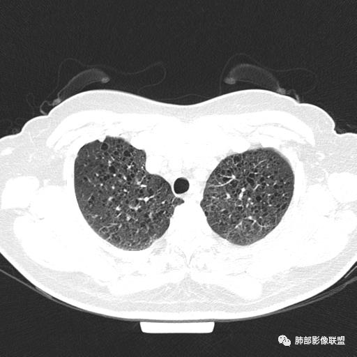 影像PPT - 【病例】中年女性,探秘双肺弥漫性囊腔-18 影像PPT - 【病例】中年女性,探秘双肺弥漫性囊腔-18