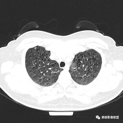 影像PPT - 【病例】中年女性,探秘双肺弥漫性囊腔-20 影像PPT - 【病例】中年女性,探秘双肺弥漫性囊腔-20
