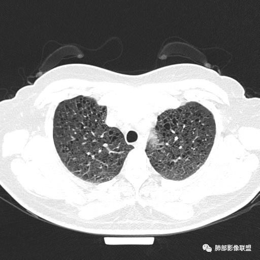 影像PPT - 【病例】中年女性,探秘双肺弥漫性囊腔-21 影像PPT - 【病例】中年女性,探秘双肺弥漫性囊腔-21