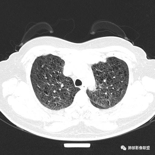 影像PPT - 【病例】中年女性,探秘双肺弥漫性囊腔-26 影像PPT - 【病例】中年女性,探秘双肺弥漫性囊腔-26