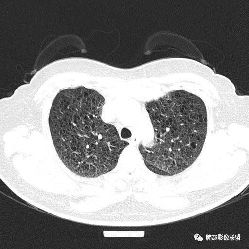 影像PPT - 【病例】中年女性,探秘双肺弥漫性囊腔-27 影像PPT - 【病例】中年女性,探秘双肺弥漫性囊腔-27