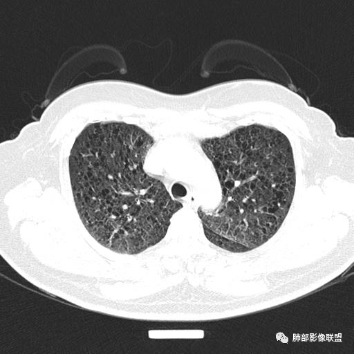 影像PPT - 【病例】中年女性,探秘双肺弥漫性囊腔-30 影像PPT - 【病例】中年女性,探秘双肺弥漫性囊腔-30