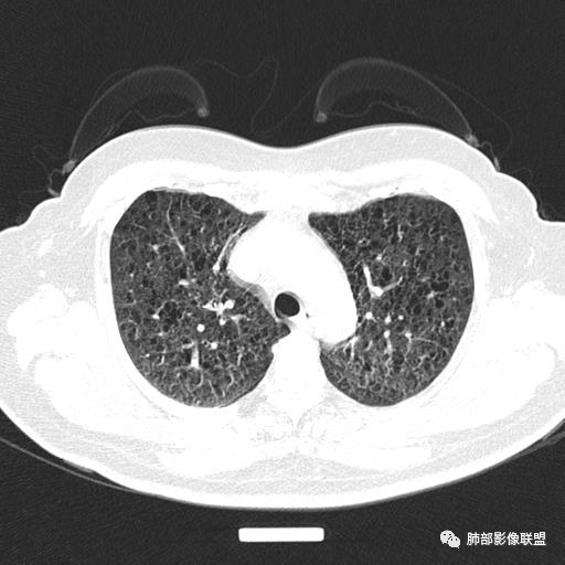 影像PPT - 【病例】中年女性,探秘双肺弥漫性囊腔-33 影像PPT - 【病例】中年女性,探秘双肺弥漫性囊腔-33