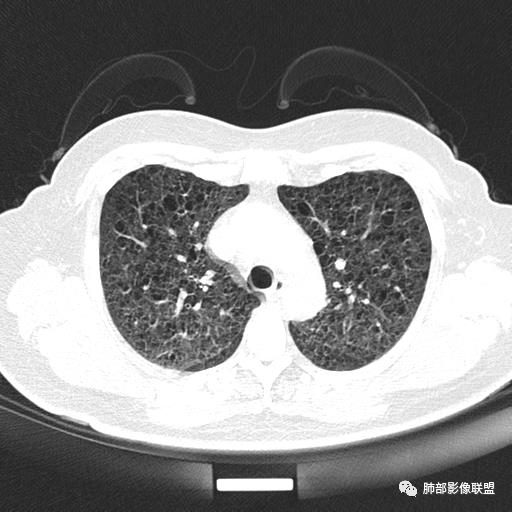影像PPT - 【病例】中年女性,探秘双肺弥漫性囊腔-37 影像PPT - 【病例】中年女性,探秘双肺弥漫性囊腔-37