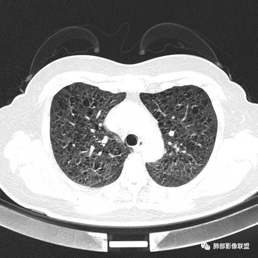 影像PPT - 【病例】中年女性,探秘双肺弥漫性囊腔-38 影像PPT - 【病例】中年女性,探秘双肺弥漫性囊腔-38