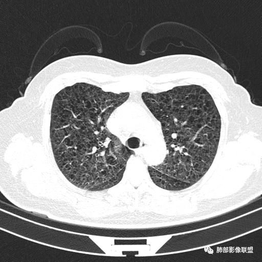 影像PPT - 【病例】中年女性,探秘双肺弥漫性囊腔-40 影像PPT - 【病例】中年女性,探秘双肺弥漫性囊腔-40