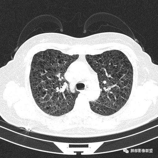 影像PPT - 【病例】中年女性,探秘双肺弥漫性囊腔-43 影像PPT - 【病例】中年女性,探秘双肺弥漫性囊腔-43