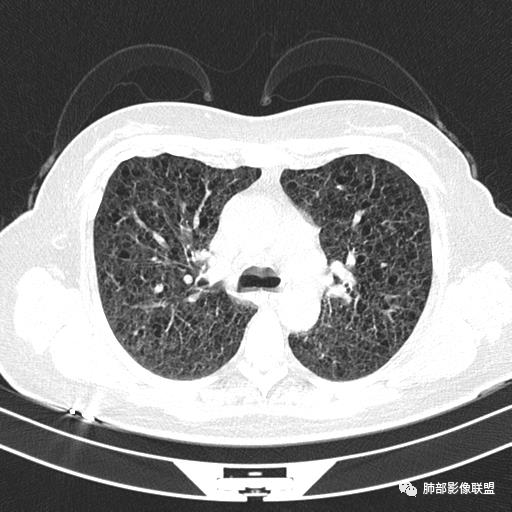 影像PPT - 【病例】中年女性,探秘双肺弥漫性囊腔-50 影像PPT - 【病例】中年女性,探秘双肺弥漫性囊腔-50
