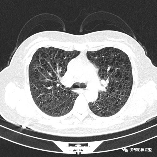 影像PPT - 【病例】中年女性,探秘双肺弥漫性囊腔-52 影像PPT - 【病例】中年女性,探秘双肺弥漫性囊腔-52