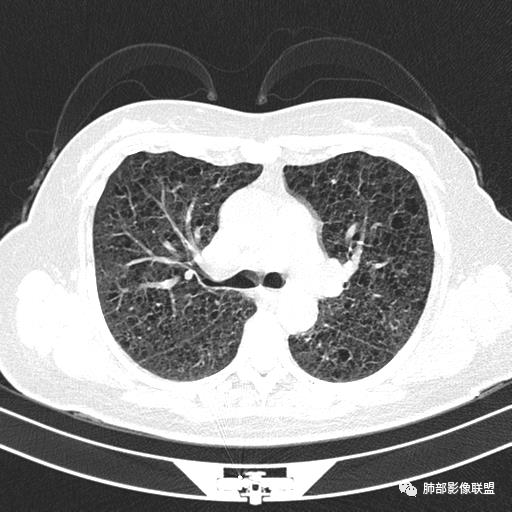 影像PPT - 【病例】中年女性,探秘双肺弥漫性囊腔-54 影像PPT - 【病例】中年女性,探秘双肺弥漫性囊腔-54