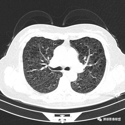 影像PPT - 【病例】中年女性,探秘双肺弥漫性囊腔-56 影像PPT - 【病例】中年女性,探秘双肺弥漫性囊腔-56