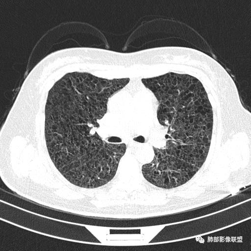 影像PPT - 【病例】中年女性,探秘双肺弥漫性囊腔-62 影像PPT - 【病例】中年女性,探秘双肺弥漫性囊腔-62