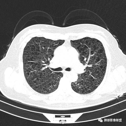 影像PPT - 【病例】中年女性,探秘双肺弥漫性囊腔-57 影像PPT - 【病例】中年女性,探秘双肺弥漫性囊腔-57